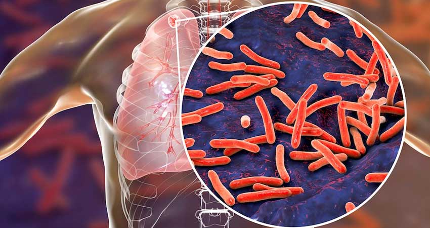 Tuberculosis Treatment in Bandra