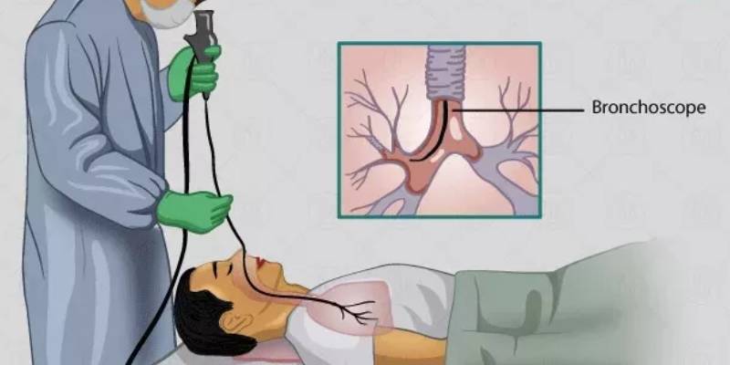 Bronchoscopy Procedure in Bandra