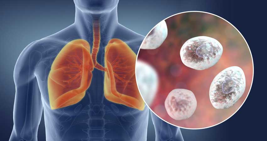 Lung Cancer Treatment in Bandra, Mahim, Santacruz